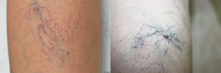 Symptoms of varicose veins