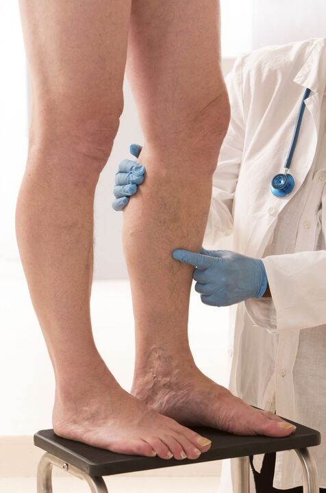 Varicosis that is