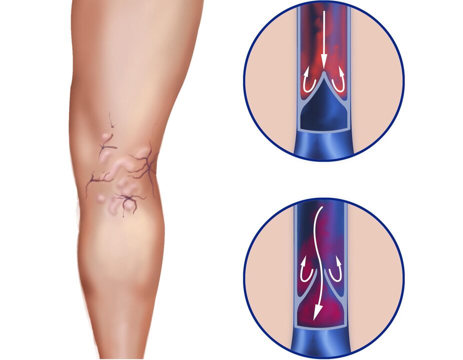 What happens to the veins for varicose veins