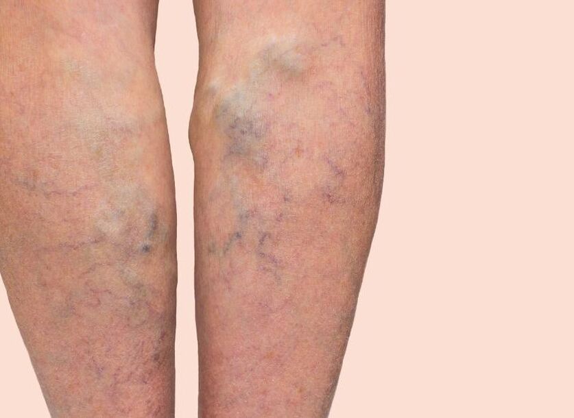 How do you see varicose veins