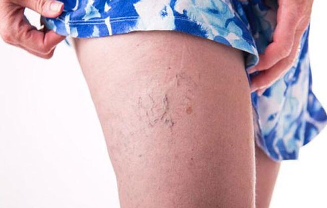 Varicose veins in the leg