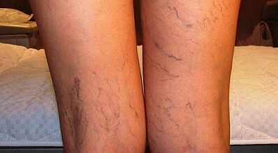 How to treat the expansion of varicone in women in women