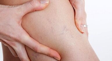 Signs and symptoms of varicose veins
