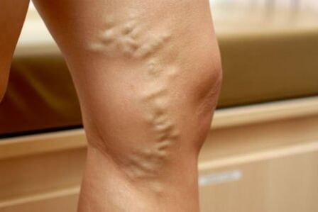 varicose vein medications