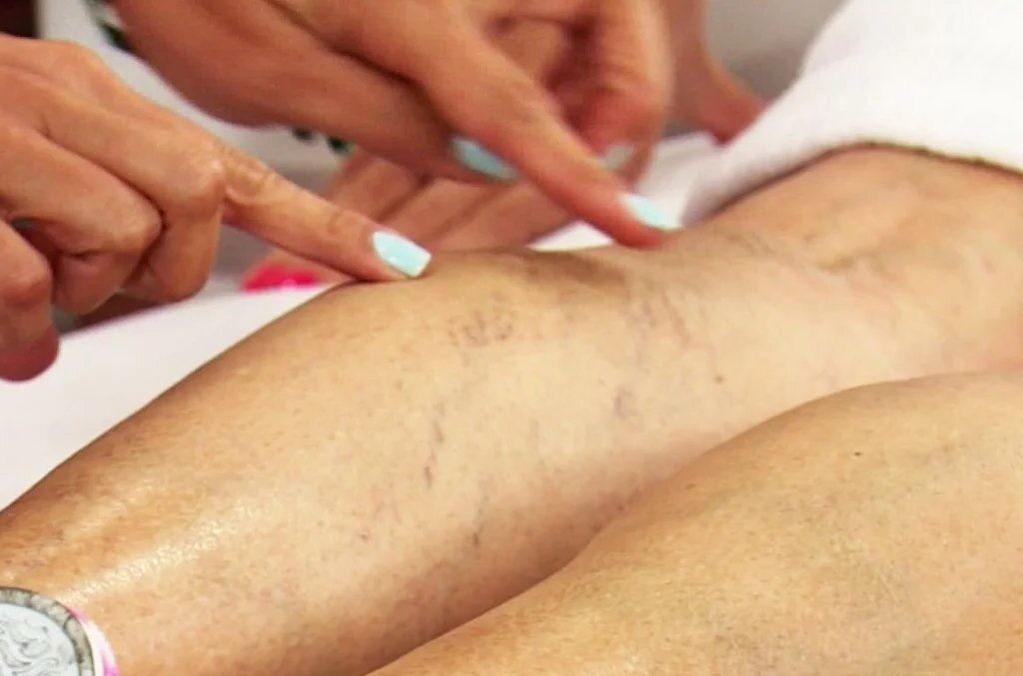 leg exam with varicose veins