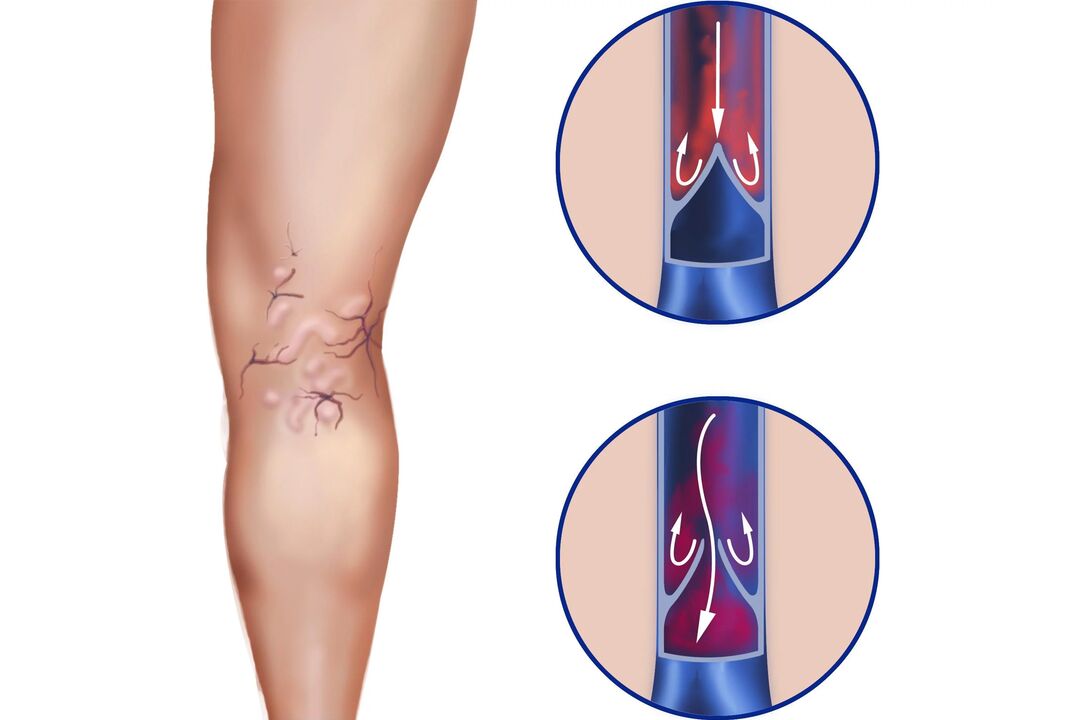 varicose veins on the legs