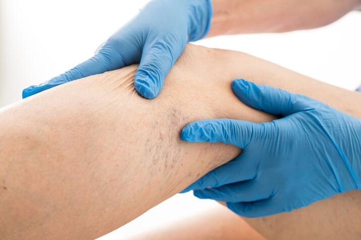 doctor examines legs with varicose veins