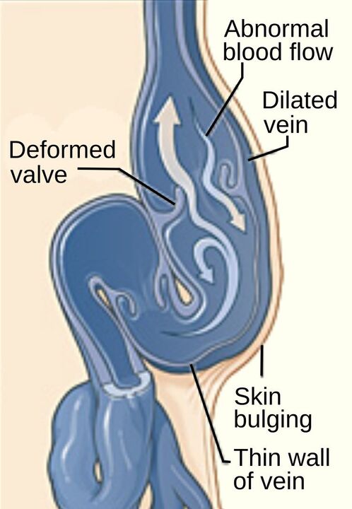 varicose vein