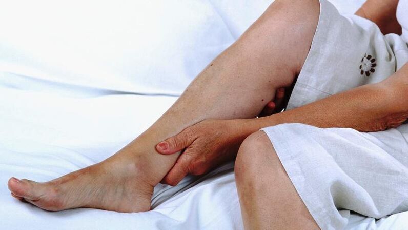 Woman suffering from varicose veins in her legs