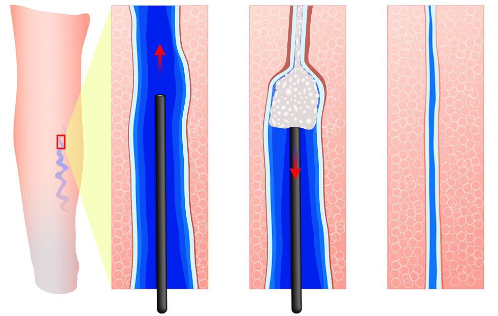 Sclerotherapy mechanism. 