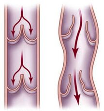 Healthy vein and altered blood flow in a varicose vein