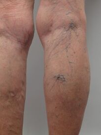 In varicose veins of the lower extremities, tortuous veins protrude from the surface of the skin. 