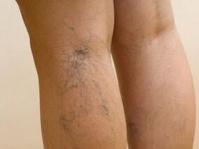 Protruding veins under the skin are a symptom of varicose veins in the legs. 