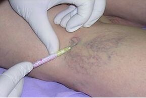 Sclerotherapy is a method of treating varicose veins in the legs. 