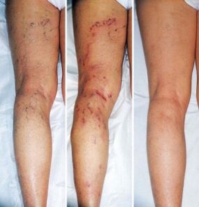 The result of treatment of varicose veins of the lower extremities. 