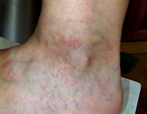 Manifestations of varicose veins of the lower extremities. 