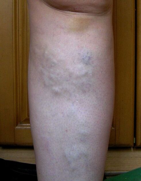 Swollen veins in the legs due to varicose veins. 